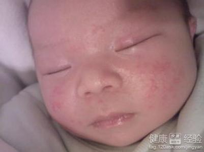 嬰兒得了藥疹要怎麼治療呢