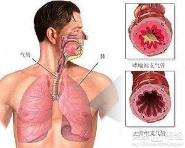 治療支氣管炎的過程中出現了藥疹怎麼辦