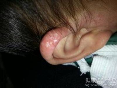 耳朵邊的水泡怎麼治療啊