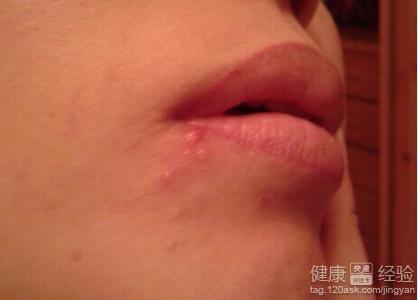 口角起水泡是什麼原因啊