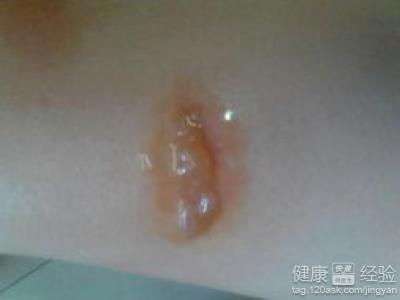 女兒腳面上起了大水泡怎麼辦啊