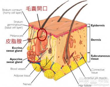 發現有皮脂腺囊腫發炎應注意哪些