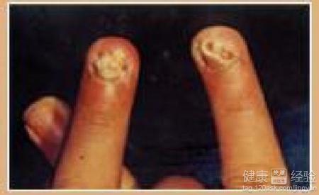 連續性指端皮炎是什麼病菌引起的