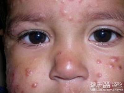 臉上長荨麻疹的症狀