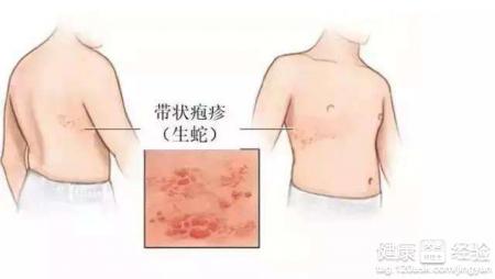 帶狀疱疹是什麼疾病