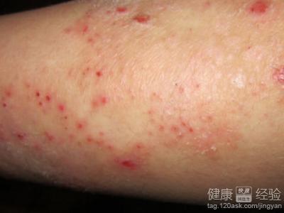 皮炎濕疹的臨床症狀是什麼?