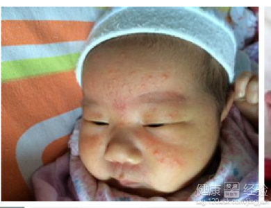 新生兒痤瘡和濕疹鑒別