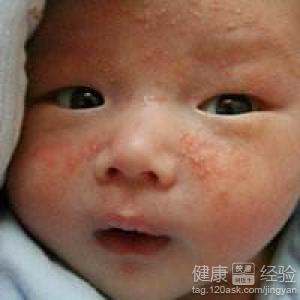 新生兒痤瘡和濕疹區別