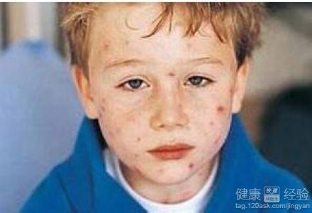 水痘對兒童的傳染性大嗎
