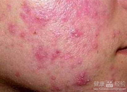 面部溢脂性皮炎有哪些症狀？