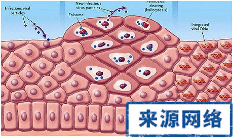 尖銳濕疣的主要危害都體現在哪些方面 尖銳濕疣的危害在生活中表現在哪些方面 尖銳濕疣對人體的危害表現在哪些方面