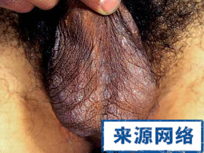 陰囊濕疹圖片 圖片大全 皮膚病圖片