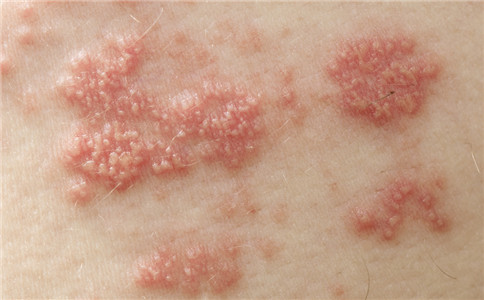 冷性荨麻疹的症狀 冷荨麻疹怎麼治療 治療冷荨麻疹的偏方