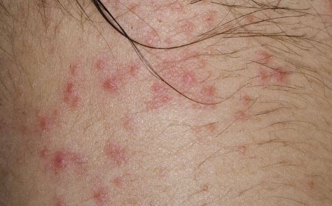 蟲咬引起的丘疹性荨麻疹 蟲咬皮炎會引發丘疹性荨麻疹嗎 蟲咬皮炎怎麼引發丘疹性荨麻疹的