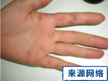 秋冬季節手脫皮症狀 秋冬季節手脫皮 手脫皮有哪些症狀呢